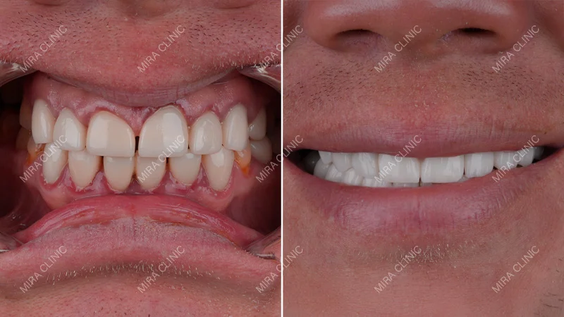 Before and After Hollywood smile 